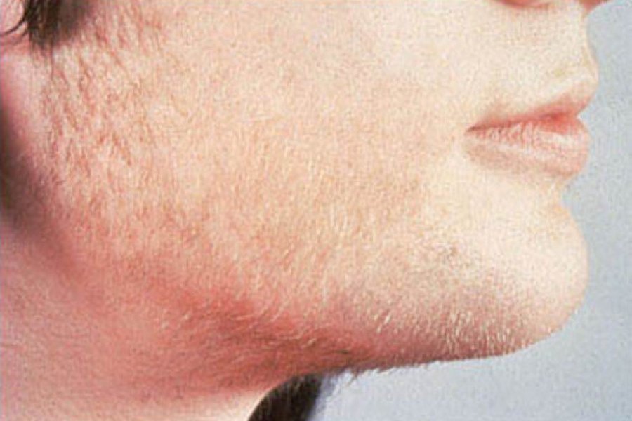Рост волос на подбородке у мужчин