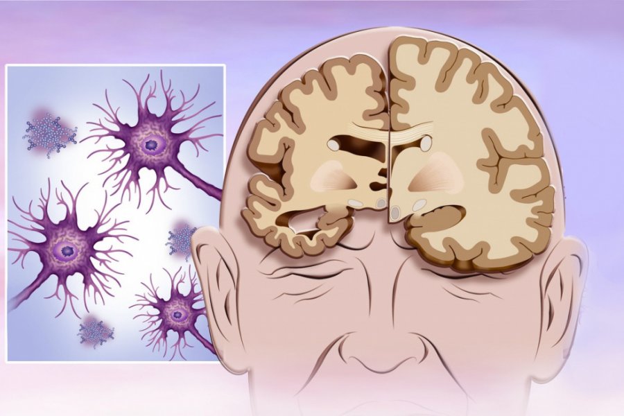 Ученые обнаружили белок Pgp, который отвечает за болезни Альцгеймера и Паркинсона